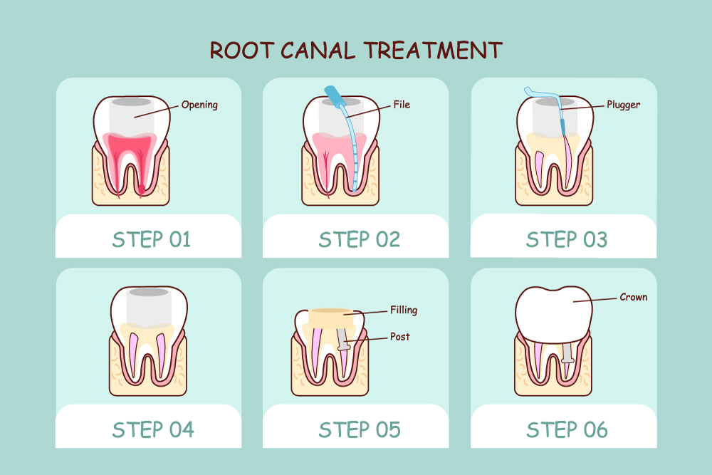 root canal treatment steps 